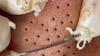 Skincare | Blackheads Removal  #tweezers skincare #blackheads blackheads