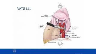 Multifocal Lung Cancer Discussion and Case Presentation