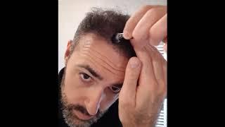 Kmax Concealing Scalp Shader on Thin Hair - Kmax Daily Routine