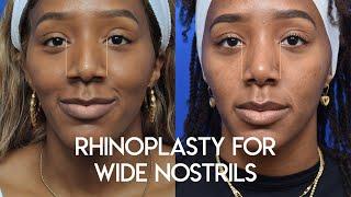 Rhinoplasty for Wide Nostrils