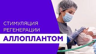 Отзыв пациентки после омоложения Аллоплантом