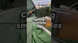  The First Cut in Laparoscopy: Why Port Insertion is a Game-Changer! 