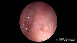 Surgery for Left Maxillary Sinus Mucocele