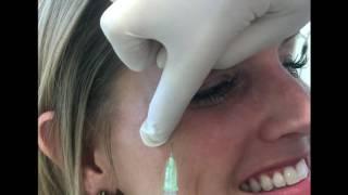 Removing Crows Feet Around The Eyes