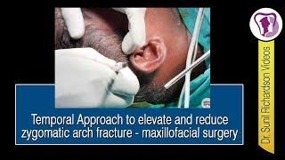 Temporal Approach to elevate and reduce zygomatic arch fracture - maxillofacial surgery @ Richardson