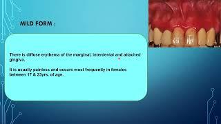 Desquamative Gingivitis