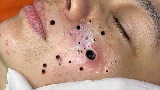 How Doctors Remove Acne From Face # 029