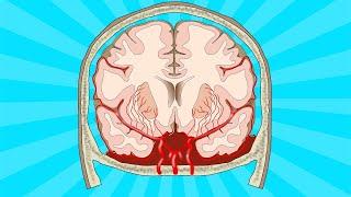 Stroke: subarachnoid haemorrhage