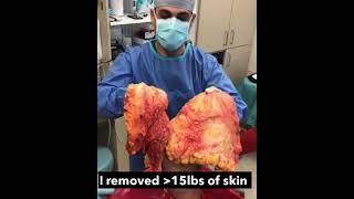 Body Lift/Contour After Weight Loss | Avance Plastic Surgery Institute: Dr. Erez Dayan | Reno, NV