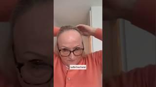This Topper Saved My Hairline! (FFA Transformation with hairline topper) | UniWigs Evelyn