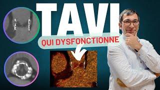 Une valve TAVI qui dysfonctionne après 2 ans : thrombose ou endocardite ?