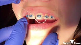 Braces Check up - 15 years old patient - Tooth Time family Dentistry New Braunfels Texas