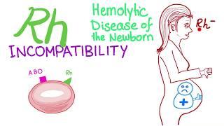 Rh incompatibility - Hemolytic disease of the newborn (HDN) - Erythroblastosis fetalis - Hemolysis
