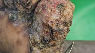 Philip Butabila -  jiggers, dead skin Day Two #3 ---long videos @riseupsociety.net & @ruskenya.org