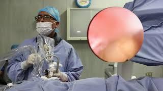 Nefrolitotripsia Percutánea Riñon Tipo 4 | Dr. Miguel Suárez Pérez | Especialista en Litiasis Renal