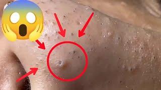 CRAVOS SATISFATÓRIOS #1 | ACNÉ ET POINT NOIR | ACNE REMOVAL BLACKHEADS AND WHITEHEADS