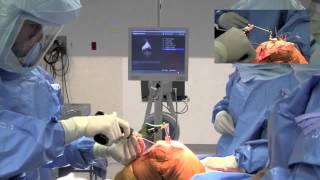 Computer Navigated Knee Replacement