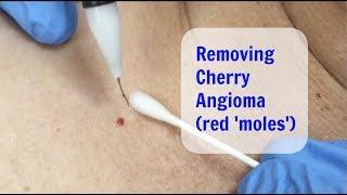 Cherry Angiomas - Cosmetic Institute of Australia