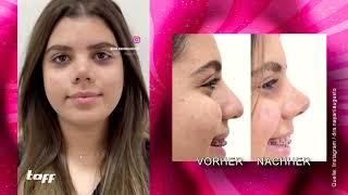 Neuester Beauty-Trend in Brasilien: zweifelhafte Eingriffe an der Nase