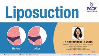 Liposuction Surgery - Procedure, Indications, Benefits and Side Effects | Liposuction Myths