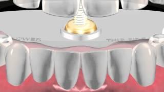 Balance A Denture Using The Massad Jaw Recorder