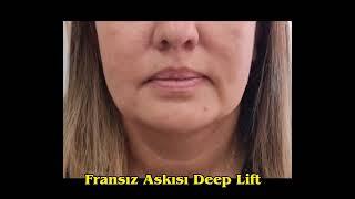 Fransız Askısı. Deep Lifting. Ameliyatsız yüz germe. #aestheticdoktoristanbul #estetik #deeplift