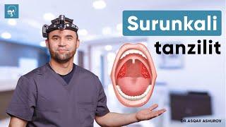 Surunkali tonzillit (angina) | Dr. Ashurov