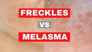 WHAT IS THE DIFFERENCE BETWEEN FRECKLES AND MELASMA?