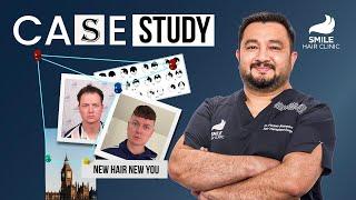 Case Study : 4200 Grafts Transformation | 12-Month Hair Transplant Results at Smile Hair Clinic