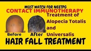 How to treat Alopecia Totalis & Universalis ? CONTACT IMMUNOTHERAPY, ,alopecia areata treatment .