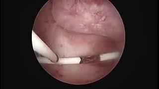 Hystroscopic view of IUD in place by Dr / waleed almery