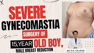 Severe Gynecomastia Surgery of 15-Year-Old Boy, Male Breast Reduction In Delhi, Dr. PK Talwar