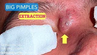 Chích nhọt to ở hốc mắt|Dermatologist,pimples,blackhead,anti acne,pustule extraction 0985773391