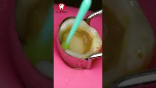 Removing Tooth Decay ASMR #shorts