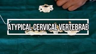 Atypical Cervical Vertebrae