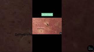 Giant Blackheads