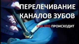 Этапы перелечивания каналов зуба