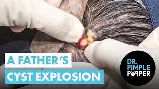 A Father’s Pilar Cyst