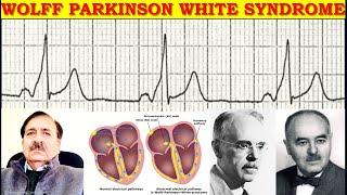 Arrhythmias associated with Wolff Parkinson White Syndrome , Lectures by Dr Alamzeb