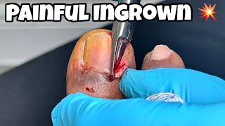 EXTREME PAINFUL INGROWN TOENAIL REMOVAL