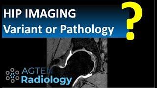 How to identify supraacetabular fossa and superior acetabular roof notch on Hip MRI