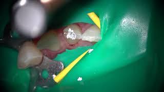 Root canal preparation to MTA obturation with an Ai motor T-mode