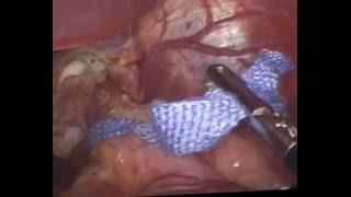 Laparoscopic fundoplication For GERD By Wael Tobar MD