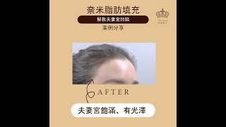 奈米脂肪填充 ▎夫妻宮飽滿、有光澤，讓你看起來更年輕！