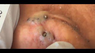 PUNTOS NEGROS TRAS LA OREJA - blackheads pimples