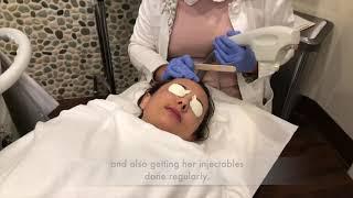 Photofacial at South Florida Center for Cosmetic Surgery with Graci