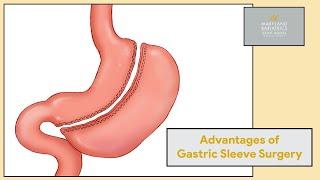 Advantages of Gastric Sleeve Surgery | Maryland Bariatric & Laparoscopic Surgeons