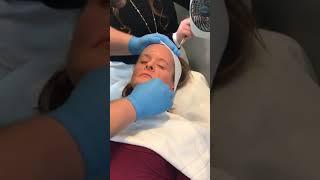 Illuminize peel by SkinMedica. Performed by Nick Miller.