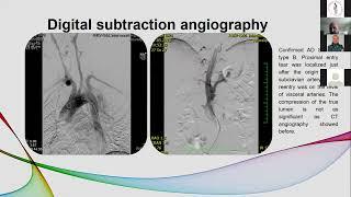 Contemporary Approach in Patients with Ascending Aorta Dilation Prodanov Science & Youth 2021