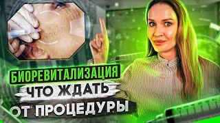 Что такое биоревитализация. Кому показана и как часто делать.